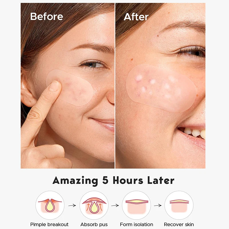 Invisible Acne Patches Anti-acne Spot Treatment Blemish Concealer Qme