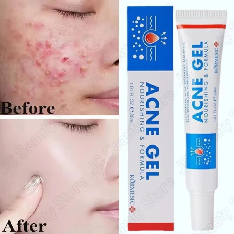 Salicylic Acid Acne Faded Face Cream Reduce Pimple Spots Deep Cleaning Pore Anti-acne Scar Oil Control Moisturizer Skin Care Qme 1pc