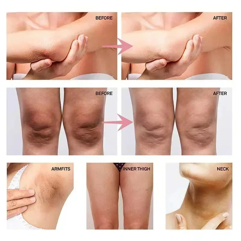 Whitening Cream Private Parts Underarm Bleaching Serum Whiten Butt Knee Brighten Inner Thigh Intimate Parts Dark Remove Melanin Qme