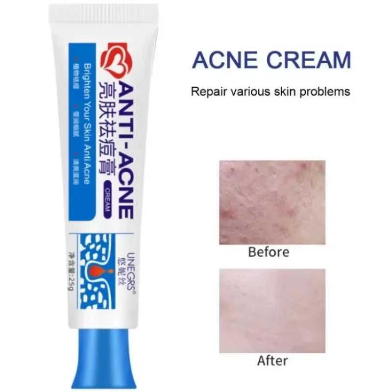 Herbal Acne Removal Face Cream Clears Pimple Scar Black Dots Gel Acne Treatment Shrink Pore Skin Whitening Lightening Ointment Qme 1pc