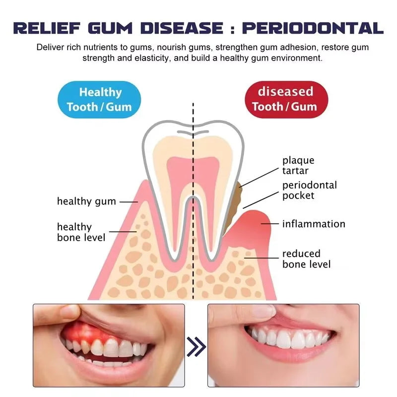 Damaged Gum Repair Care Gel Relieve Sore Gums Allergy Deep Cleaning Teeth Stains Tartar Serum Dental Caries Toothpaste Qme