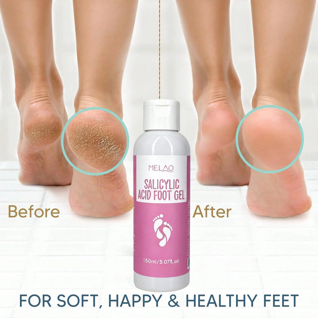 MELAO Salicylic Acid Foot Gel - Dead Skin & Callus Remover, Exfoliating Treatment for Rough Cracked Feet, Softens Heels, 150ml Qme