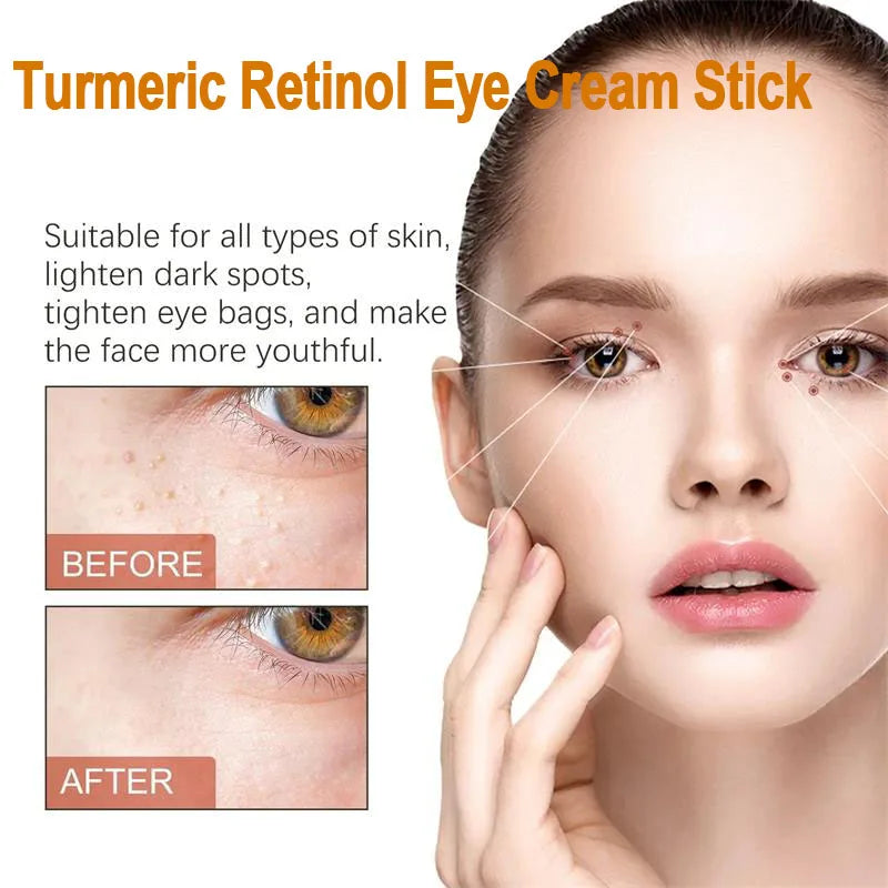 Fat Granules Remover Eye Cream Anti-Puffiness Anti Inflammatory Reduce Dark Circles Eyebags Fade Lines Moisturizing Eye Care Qme