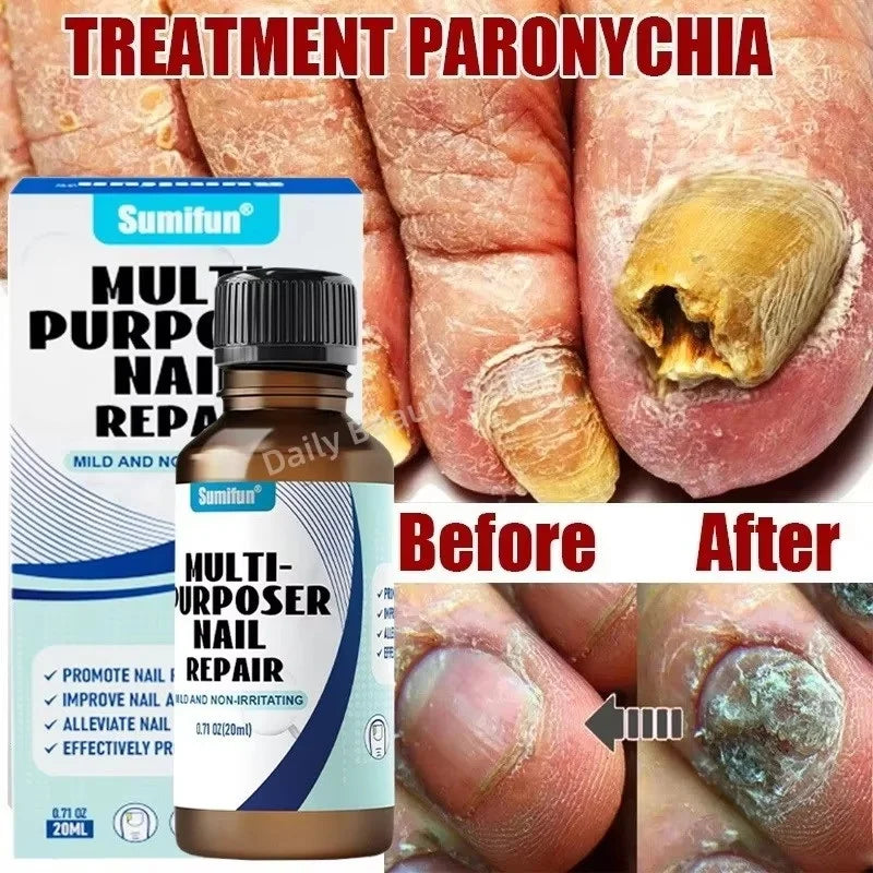 Fungal Nail Treatment Serum Foot Nail Fungus Removal Repair Gel Anti Infection Paronychia Onychomycosis Foot Nails Care Essence Qme