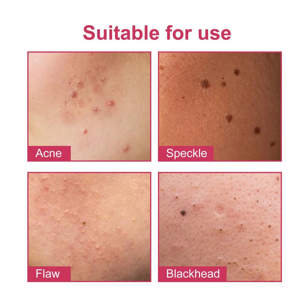 Star Pimple Patch Acne Colorful Invisible Removal Skin Care Stickers Qme