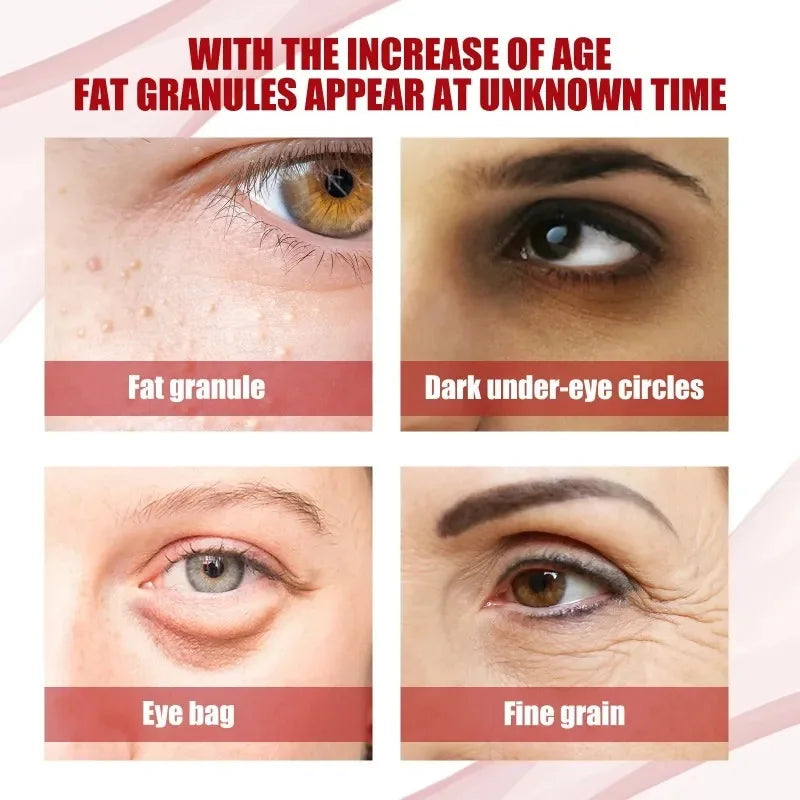 Fat Granules Remover Eye Cream Anti-Puffiness Anti Inflammatory Reduce Dark Circles Eyebags Fade Lines Moisturizing Eye Care Qme