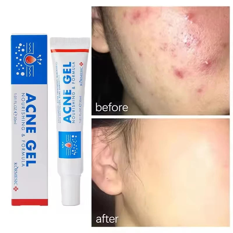 Salicylic Acid Acne Faded Face Cream Reduce Pimple Spots Deep Cleaning Pore Anti-acne Scar Oil Control Moisturizer Skin Care Qme