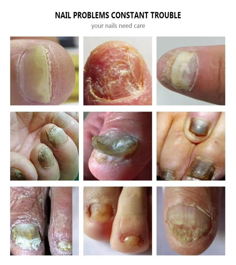 Nail Fungal Treatment Serum Foot Toe Nail Fungus Removal Essential Oil Anti Infection Onychomycosis Paronychia Repairing Care Qme
