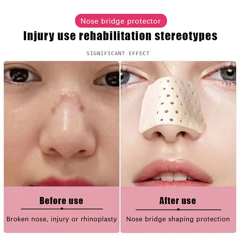 Self-shaping Nose Splint Low Temperature Thermoplastic Job Adhesive Qme