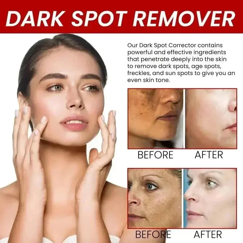 Powerful Spot-Removing Whiten Cream Brighten Skin Fast Eliminates Melanin Pigmentation Melasma Dark Spots Korean Face Skin Care Qme