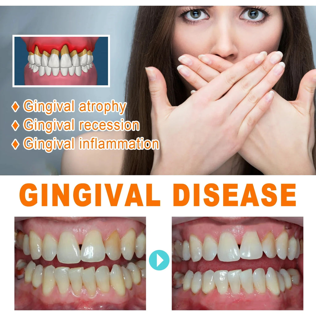 Fast Gum Repair Drops 7 Days Relieve Bleeding Sensitive Gums Soothe Inflammation Repair Gum Line Whiten Teeth Natural Oral Care Qme