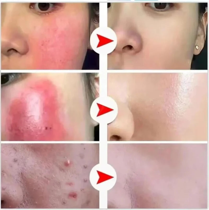 Facial Redness Repair Serum Improve Sensitive Skin Dryness Moisturizer Hydrating Sooth Lotion Removal Rosacea Korean Cosmetics Qme