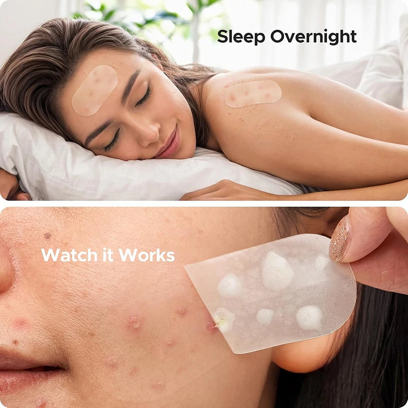 Invisible Acne Treatment Patches Blemish Spot Concealing Repair Qme