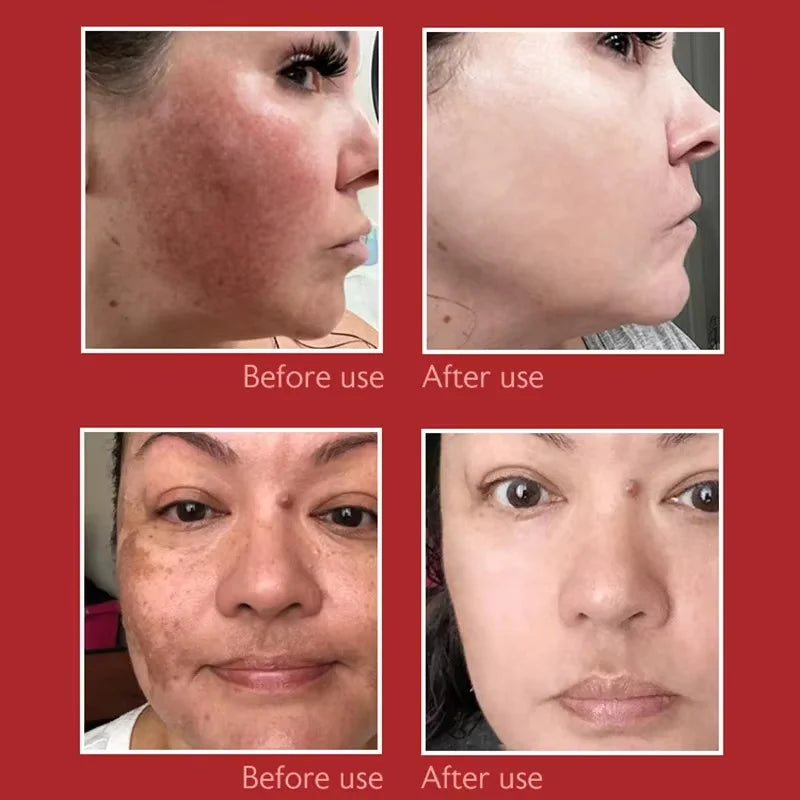 Whitening Freckle Cream Reduce Dark Spots Anti Freckle Face Creams Niacinamide Fade Pigmentation Melasma Brighten Skin Care 20g Qme