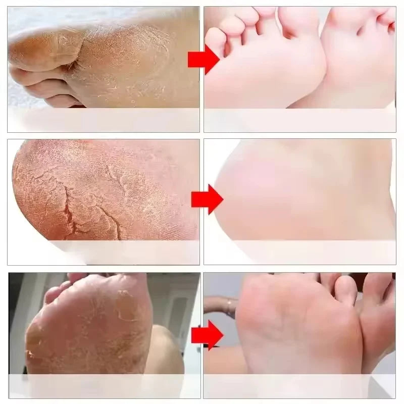 Foot Cuticle Remove Dead Foot Exfoliator Softener Remove Dead Skin and Calluses Foot Mask Pedicure Nail Enhancer Qme