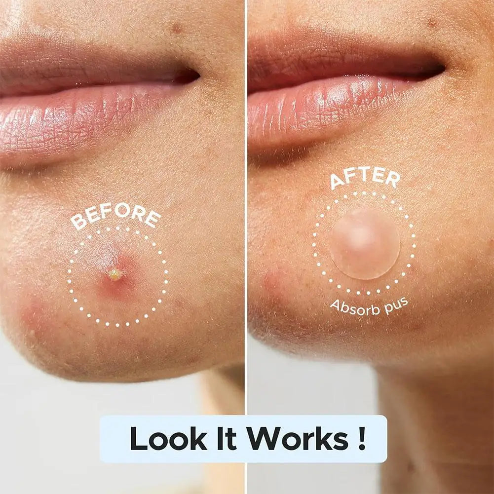 1/10/300pcs Special shaped acne patch Invisible Pimple Cover For Face Oil Control Spot Treatment Sticker Acne Tool Qme