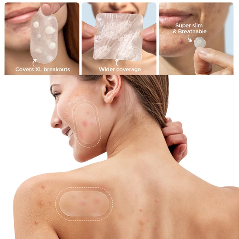 Invisible Acne Treatment Patches Blemish Spot Concealing Repair Qme