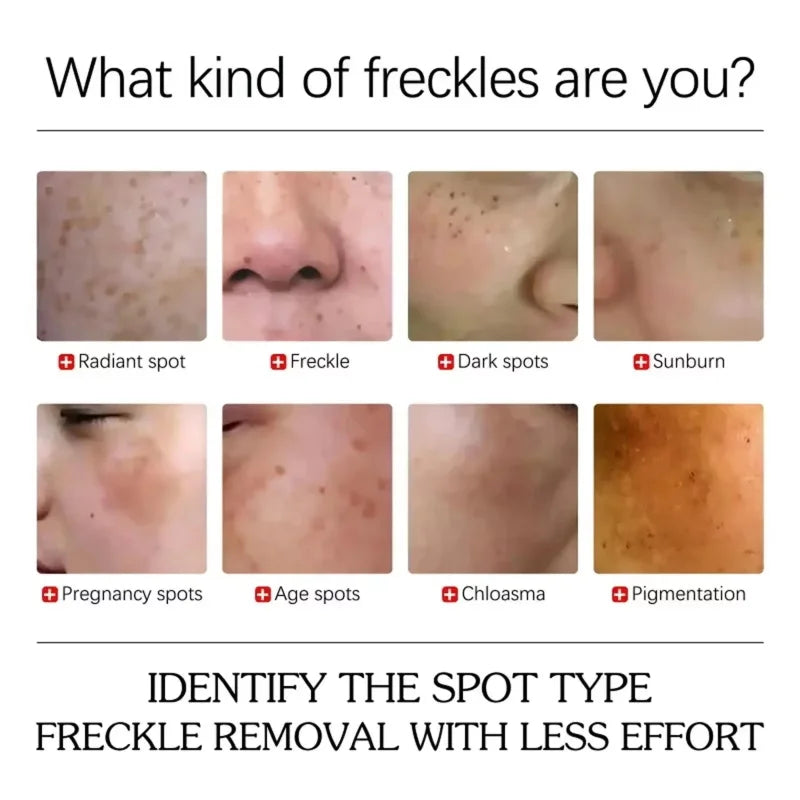 Turmeric Freckle Removing Whitening Essence Fade Pigmentation Melasma Dark Spots Corrector Repair Serum Korean Skin Care Qme