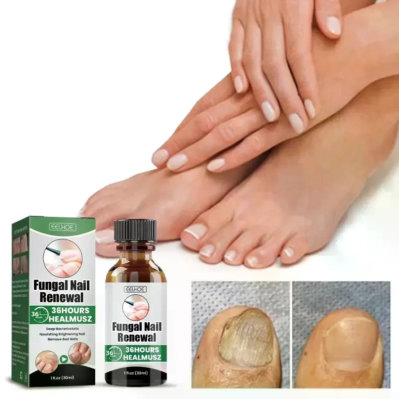 Fungal Nail Removal Herbal Nourishing Solution Brightening Daily Care Qme