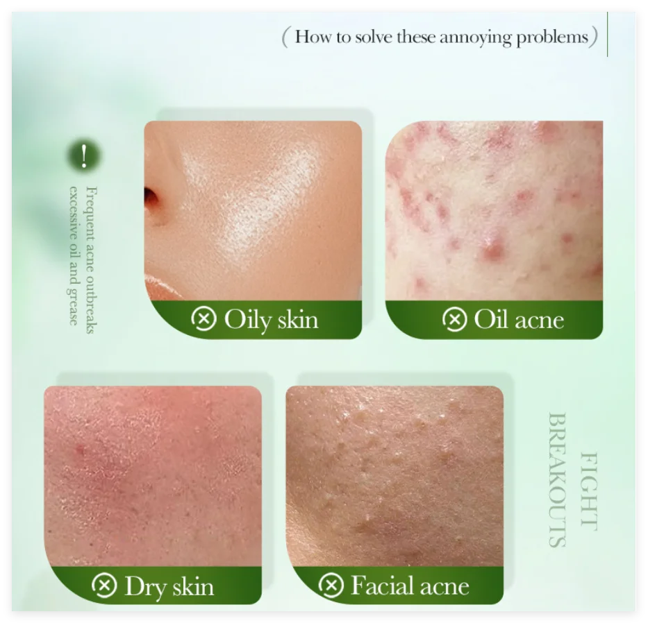 Salicylic Acid Acne Treatment Face Cream Repair Pimple Spots Deep Cleaning Pore Anti-acne Scar Oil Control Moisturizer Skin Care Qme