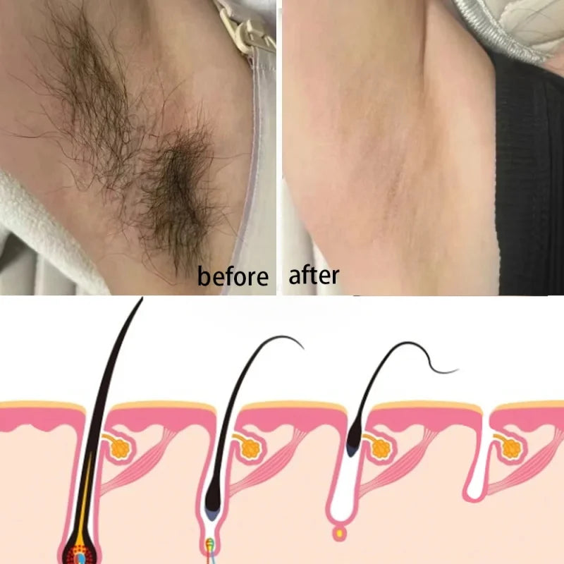 Permanent Hair Removal Cream Hair Growth Inhibitor Face Arm Armpit Leg Intimate Areas Painless Depilatory For Men Women Care Qme