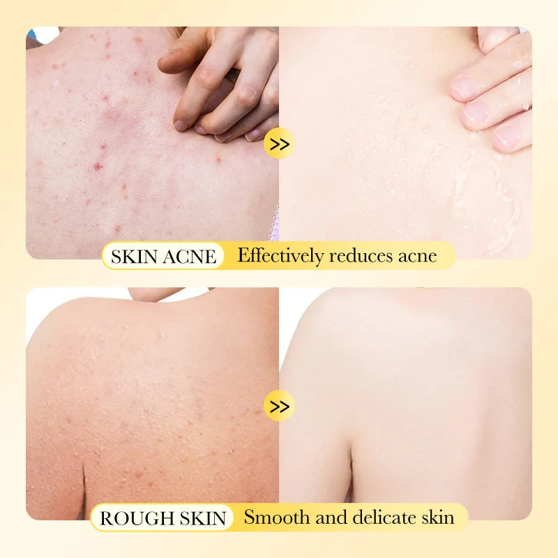 Sulfur Soap Gently Cleanses Removes Dirt Providing Deep Cleaning Qme