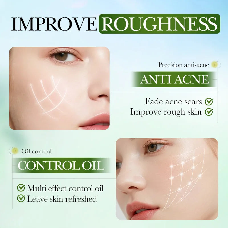 Salicylic Acid Acne Treatment Face Cream Repair Pimple Spots Deep Cleaning Pore Anti-acne Scar Oil Control Moisturizer Skin Care Qme
