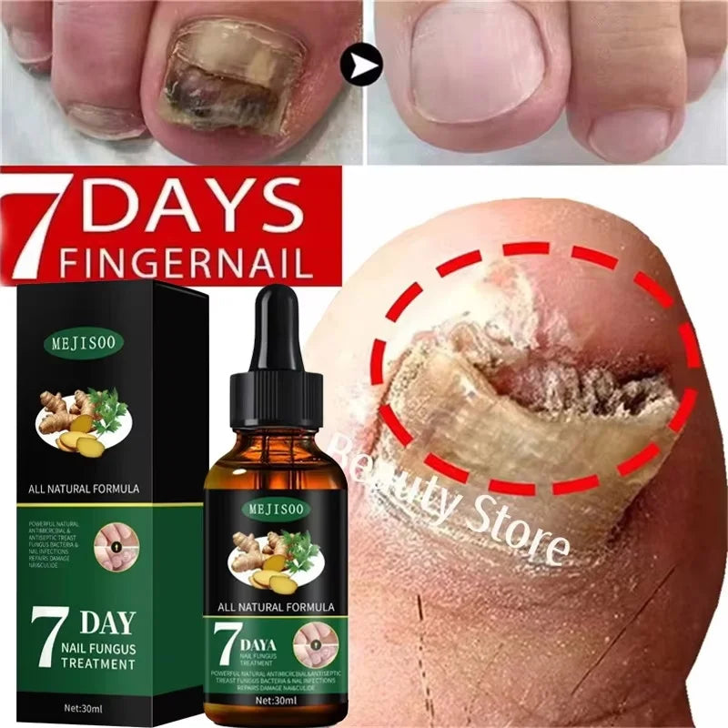 Nail Fungus Repair Serum Foot Alleviate Liquid Toe Nails Fungal Removal Gel Anti Infection Paronychia Onychomycosis Cream Qme