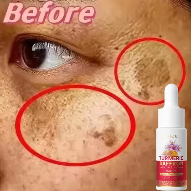 Turmeric Freckle Removing Whitening Essence Fade Pigmentation Melasma Dark Spots Corrector Repair Serum Korean Skin Care Qme