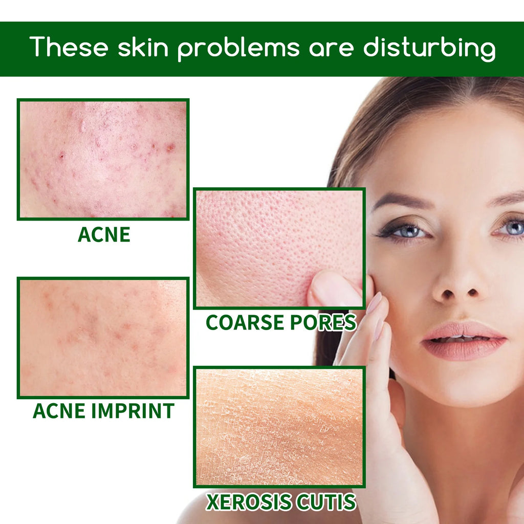 Salicylic Acid Anti Acn-e Face Serum Hydrating Fader Acne Mark Pimple Blackhead Removal Shrink Pores Oil Control Facial Essence Qme