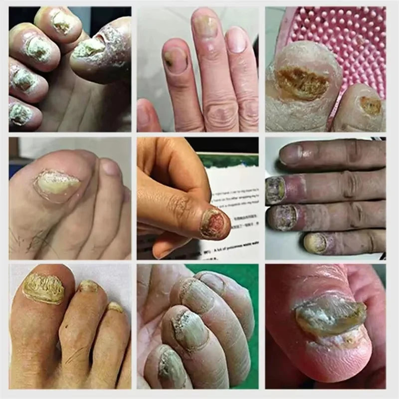 Fungal Nail Treatment Serum Foot Nail Fungus Removal Repair Gel Anti Infection Paronychia Onychomycosis Foot Nails Care Essence Qme