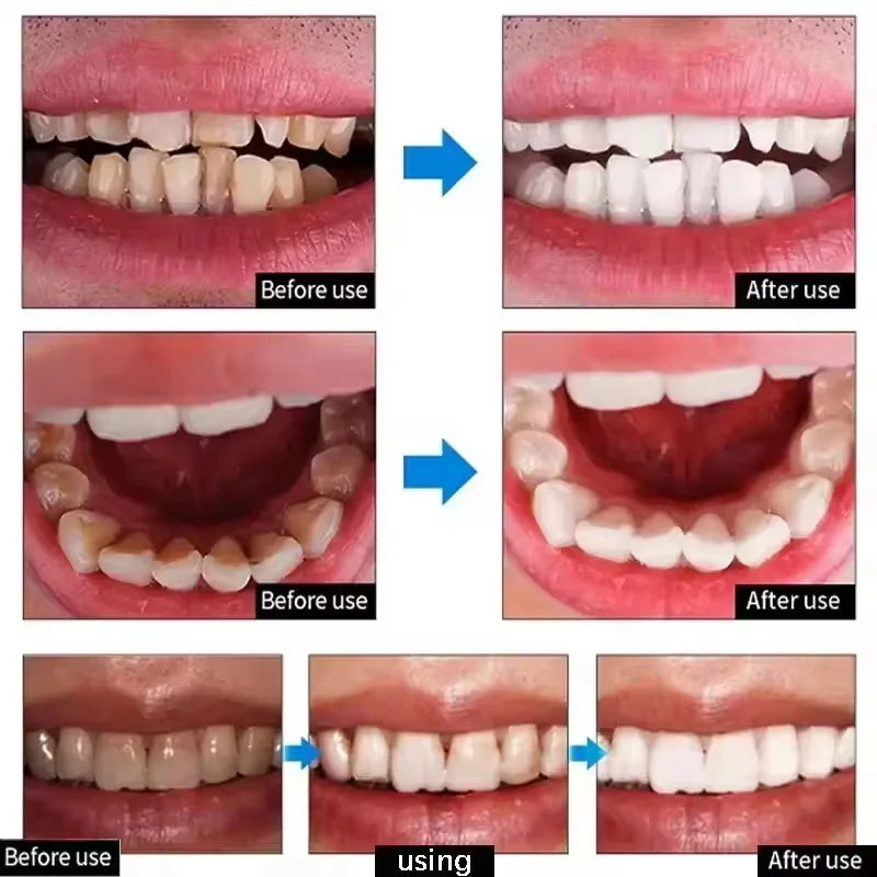 Teeth Removing Deep Smoke Stains Gingiva Protection Purple Orthopedic Toothpaste Effectively Cleans Oral Cavity Brightens Qme