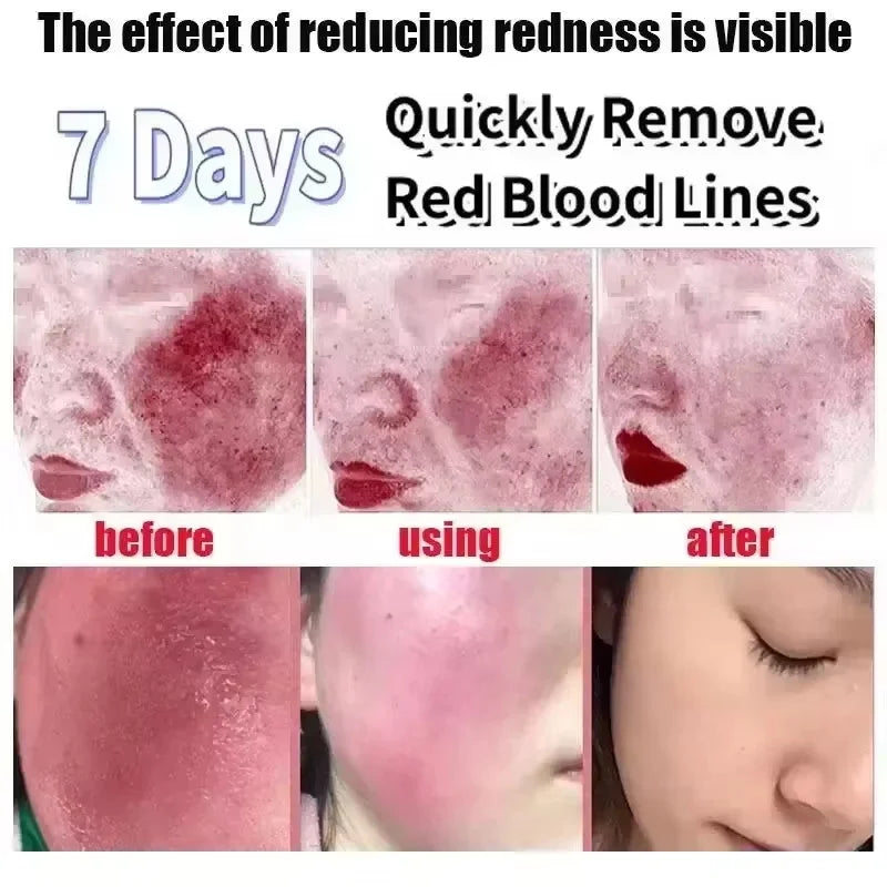 Facial Redness Reduce Cream Improve Sensitive Skin Dryness Moisturizer Hydrating Sooth Lotion Rosacea Decrease Korean Cosmetics Qme