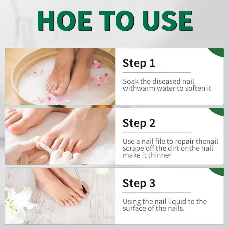 Fungal Nail Treatment Serum 7 Days Fungus Removal Treating Paronychia Liquid Anti Gray Nails Infection Foot Repair Care Tools Qme