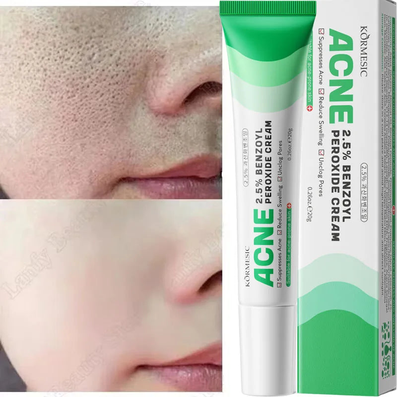 Salicylic Acid Pore Clearing Cream Shrink Pores Remove Blackheads Acne Brighten Moisturizing Smooth Skin Care Korean Products Qme 1pc