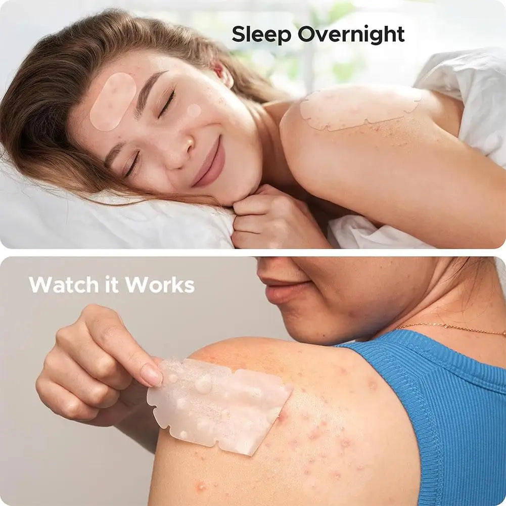 Large Pimple Patches Bulk Face 5 Sizes Hydrocolloid Acne Covering Qme