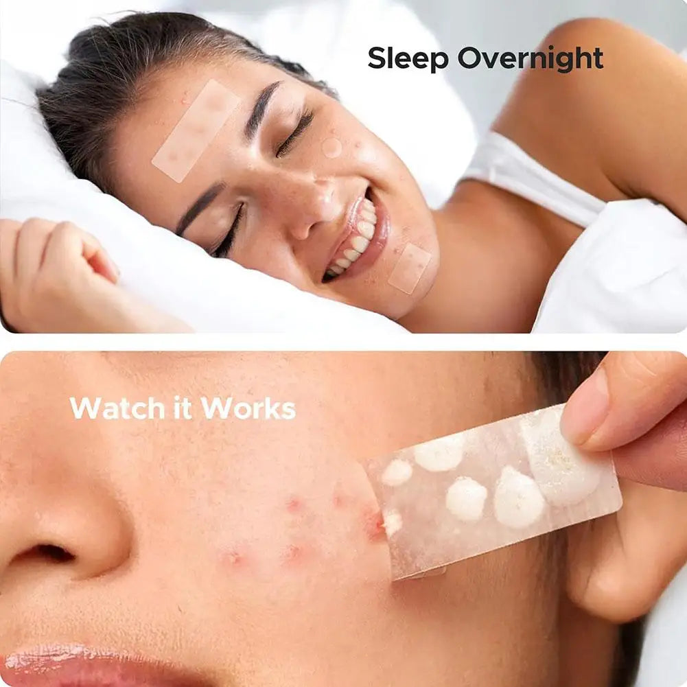 Mixed Sizes Hydrocolloid Pimple Patches For Face Salicylic Acid Hydrocolloid Invisible Acne Stickers For Zits Spots Qme
