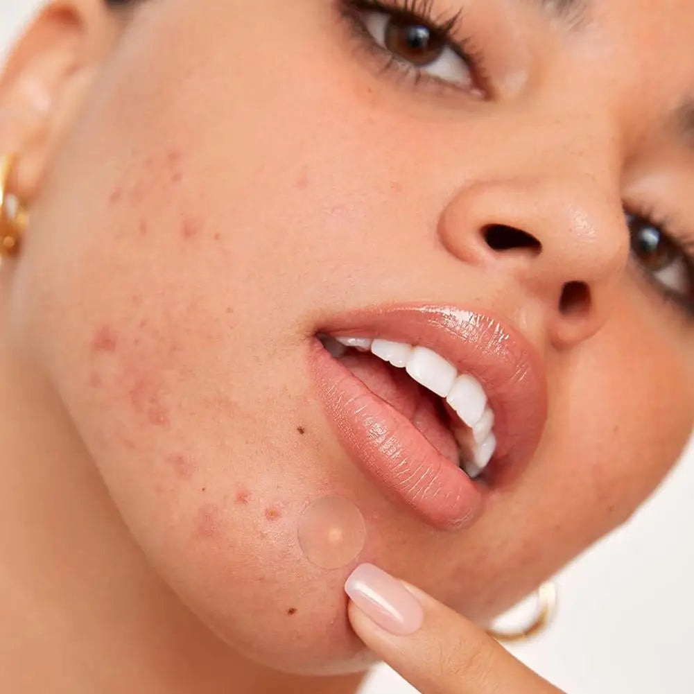 Invisible Hydrocolloid Patches For Covering Zits And Blemishes, Acne Pimple Patches For Face Spot Stickers For All Skin Types Qme