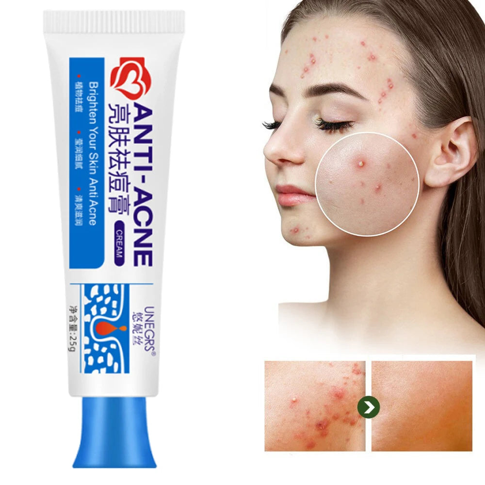 Herbal Acne Removal Face Cream Clears Pimple Scar Black Dots Gel Acne Treatment Shrink Pore Skin Whitening Lightening Ointment Qme