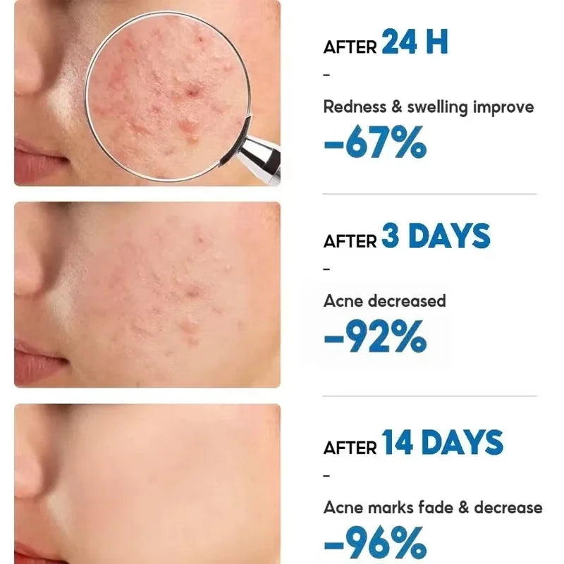 Herbal Acne Removal Face Cream Clears Pimple Scar Black Dots Gel Acne Treatment Shrink Pore Skin Whitening Lightening Ointment Qme