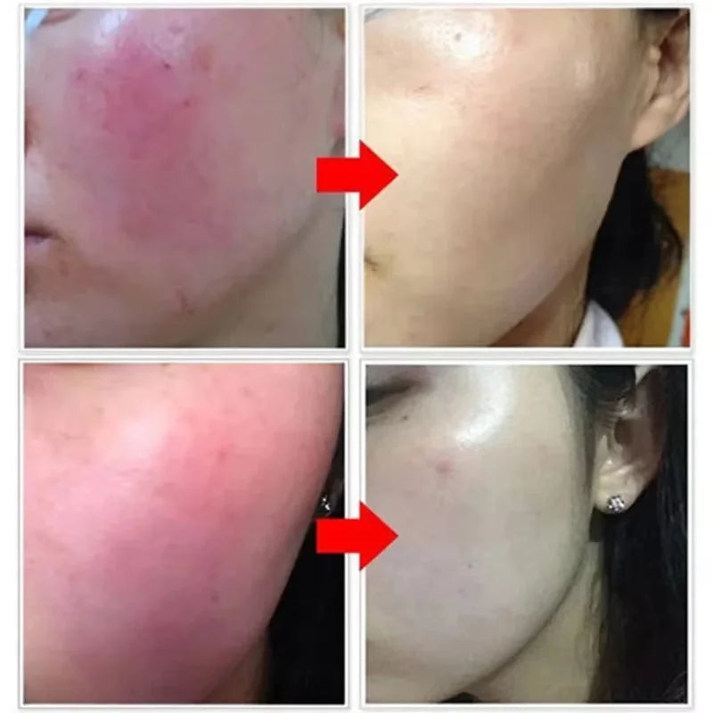 Facial Redness Repair Essence Improve Sensitive Skin Dryness Moisturizer Hydrating Sooth Lotion Removal Rosacea Korean Cosmetics Qme