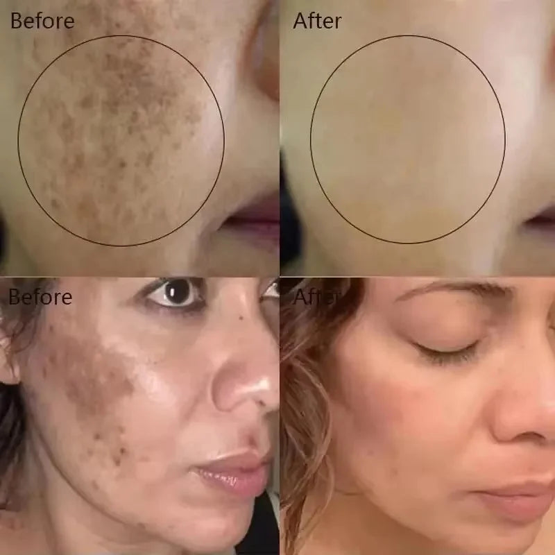 Vitamin C Whitening Serum Remove Freckles Dark Spots Face Essence Fade Melasma Melanin Brighten Repair Dull Skin Care Cosmetics Qme
