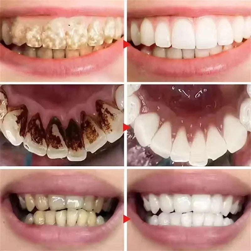 Teeth Removing Deep Smoke Stains Gingiva Protection Purple Orthopedic Toothpaste Effectively Cleans Oral Cavity Brightens Qme