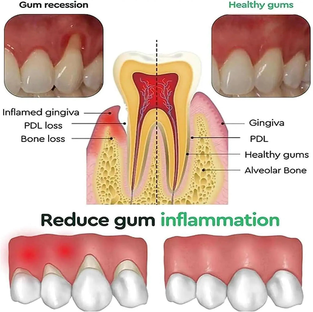 Damaged Gum Repair Care Toothpaste Relieve Sore Gums Allergy Deep Cleaning Teeth Stains Tartar Serum Dental Caries Toothpaste Qme
