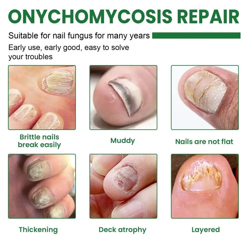 Nail Fungus Device Toenail Fingernail Restoration Onychomycosis Qme