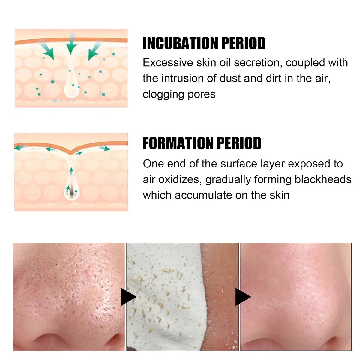 Blackhead Remover Nose Patches 10- Deep Clean Gentle Certified Qme