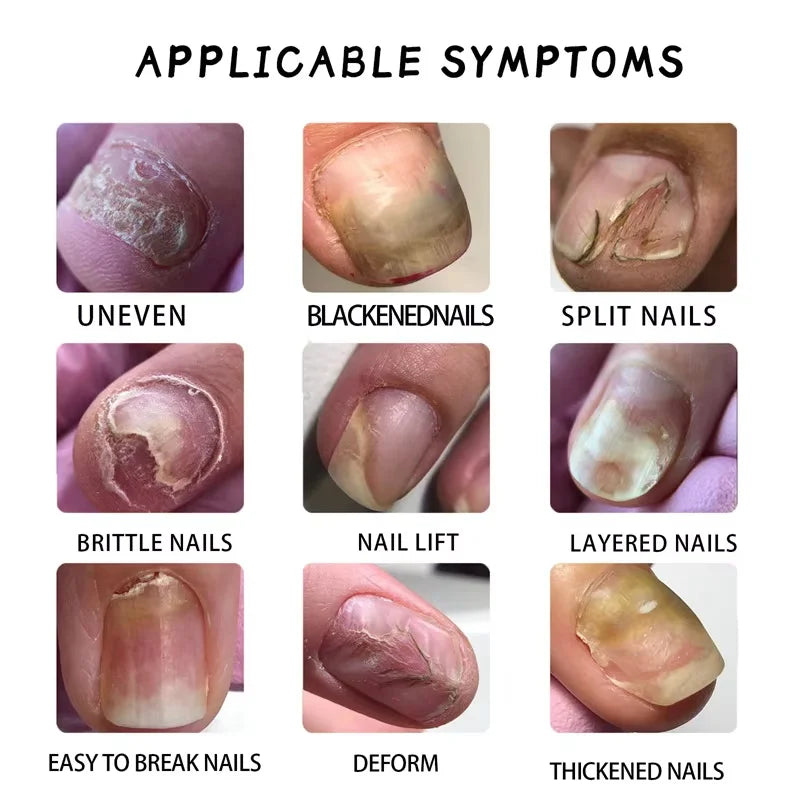 Fungal Nail Treatment Serum 7 Days Fungus Removal Treating Paronychia Liquid Anti Gray Nails Infection Foot Repair Care Tools Qme