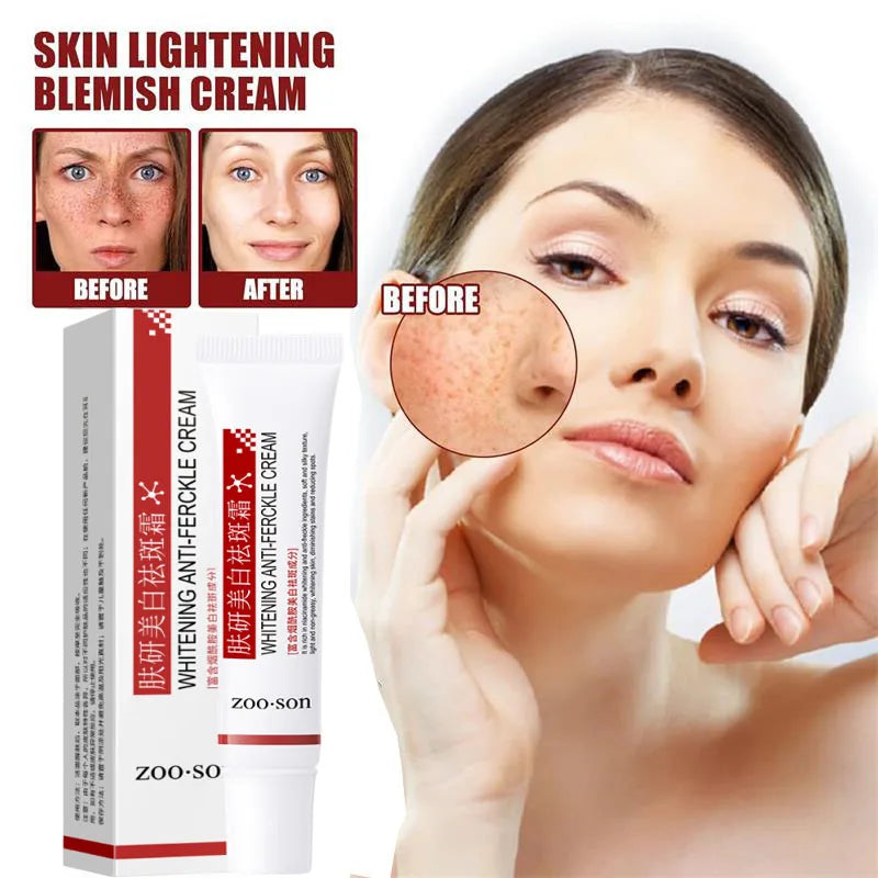 Whitening Freckle Cream Remove Dark Spots Anti Freckle Face Creams Niacinamide Fade Pigmentation Melasma Brighten Skin Care 20g Qme