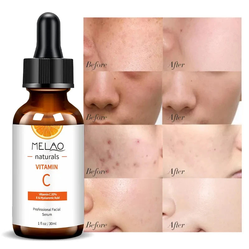 MELAO Vitamin C Serum with 20% Hyaluronic Acid & Vitamin E Anti Aging Anti Wrinkle Brightening Dark Spot Face Essence Qme