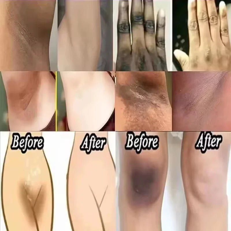 Whitening Cream For Dark Skin Underarm Bleaching Armpit Lightening And Intimate Area Woman Moisturizer Korean Skin Care Products Qme